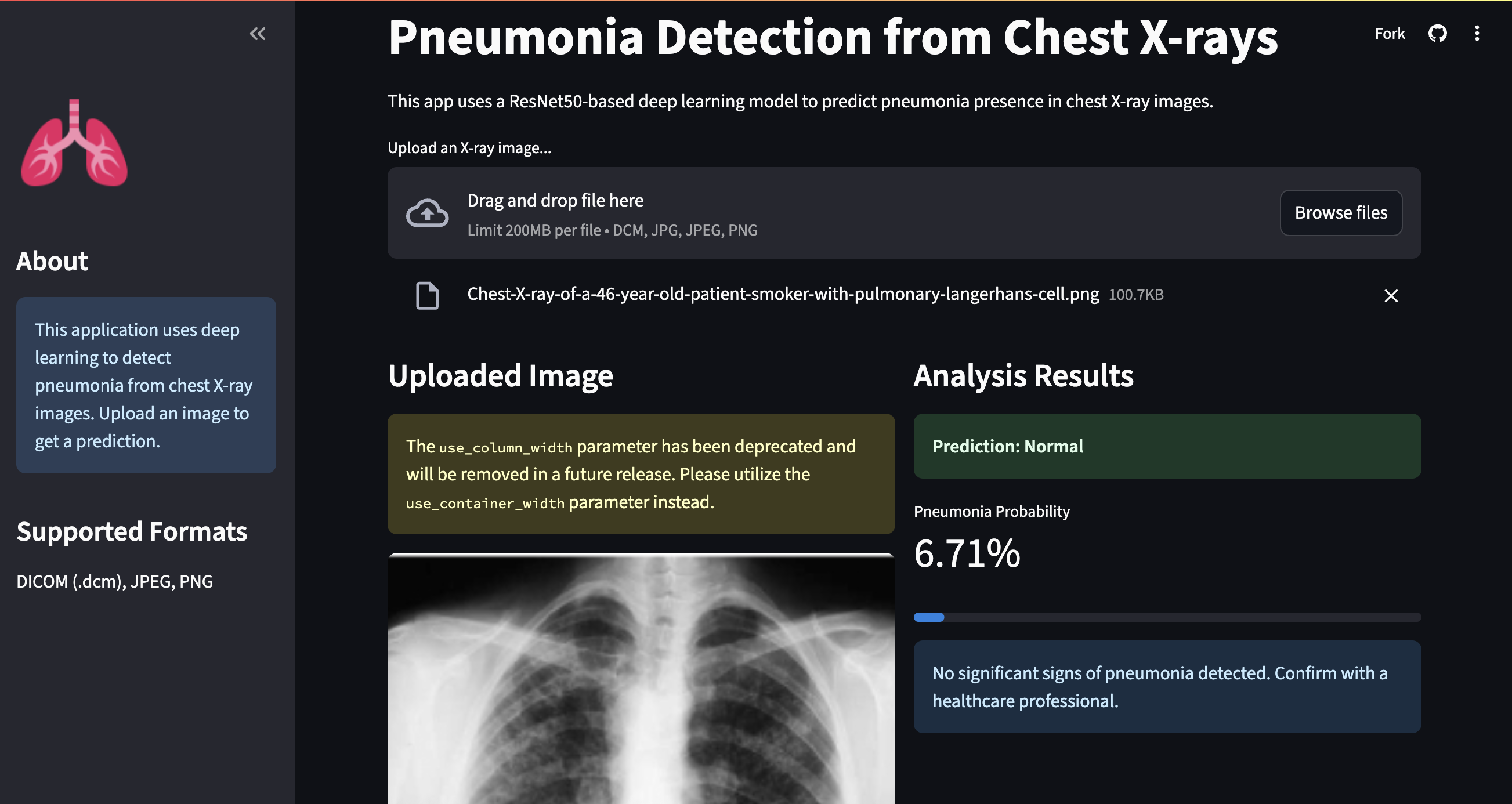Screenshot of pneumonia detection